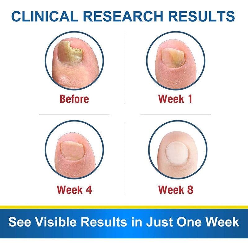 7DAYS Θεραπεία Μύκητα Νυχιών