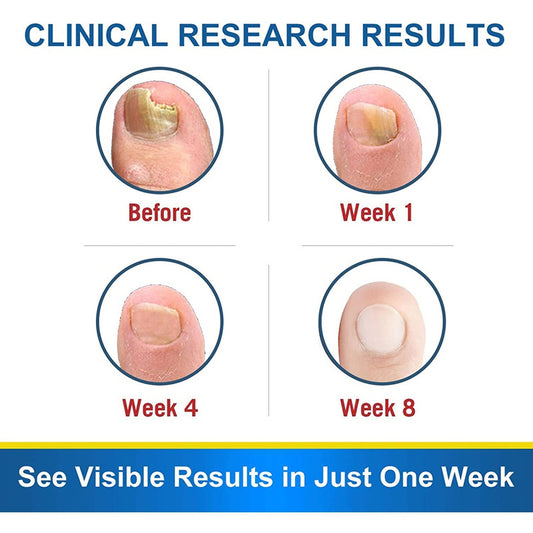 7DAYS Θεραπεία Μύκητα Νυχιών